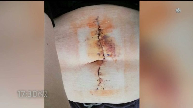 Nach Kaiserschnitt 1,5 Meter Darm verloren (Foto: SAT.1 NRW)