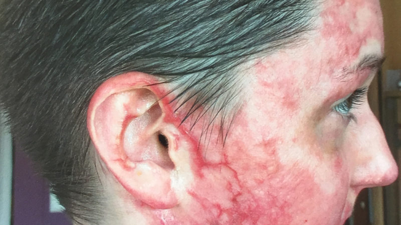 Abiturientin von Mitschüler angezündet (Foto: SAT.1 NRW)
